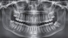 Panoramic X-Ray
